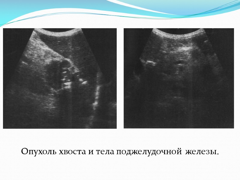 Опухоль хвоста и тела поджелудочной железы.